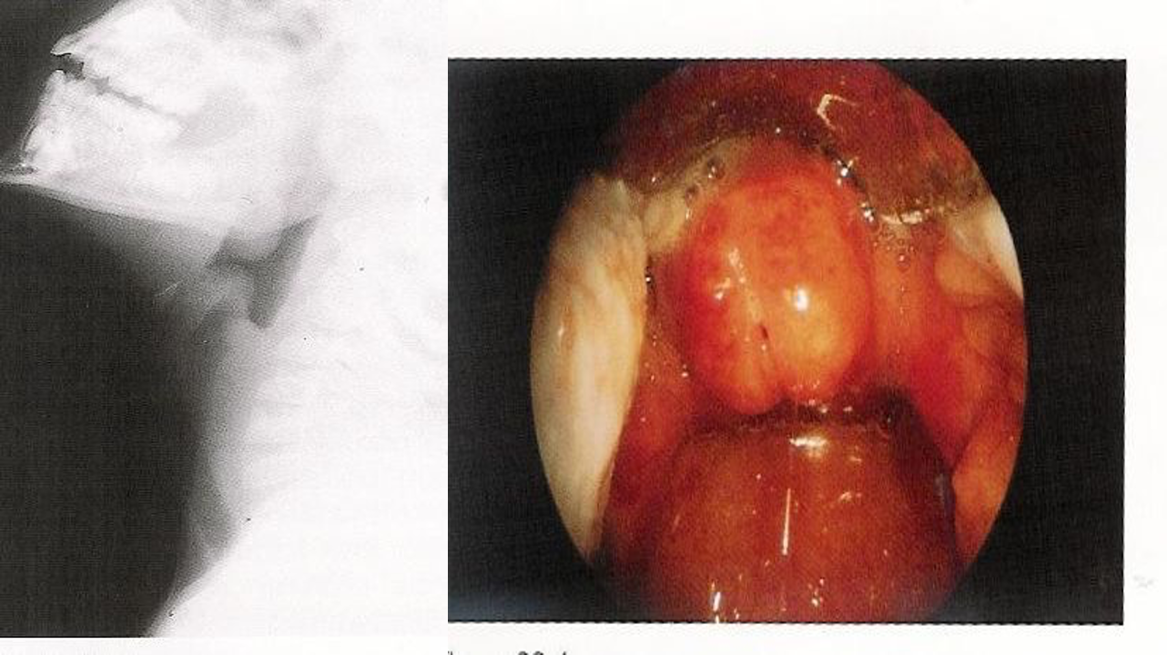 Acute Epiglottitis