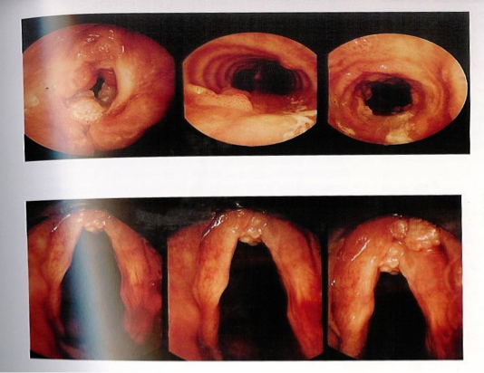 Recurrent Respiratory Papillomatosis