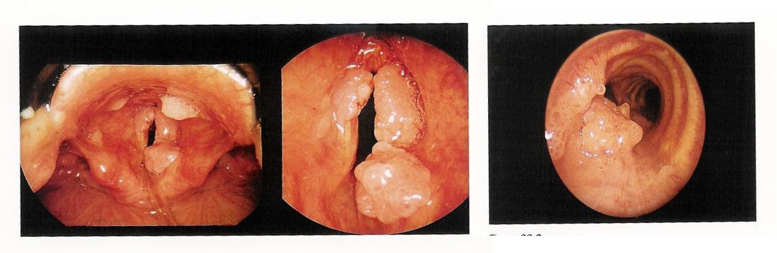 Recurrent Respiratory Papillomatosis