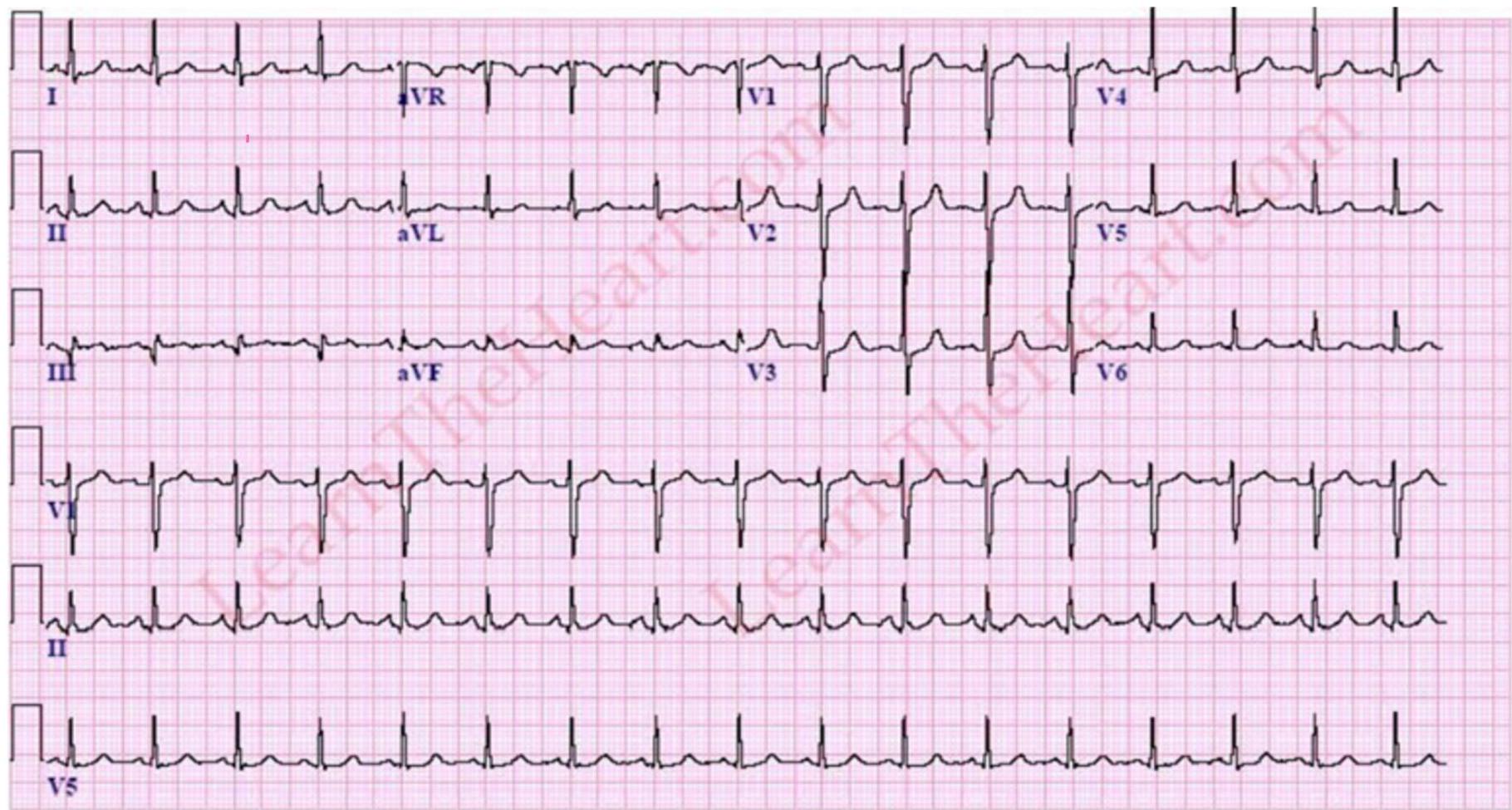 Case 1 ECG