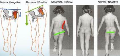 Trendelenburg Test detailed