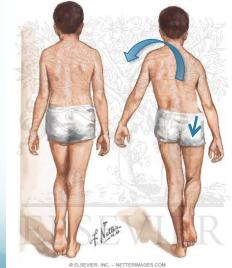 Trendelenburg results