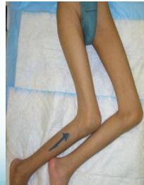 Bilateral hip abnormal positioning