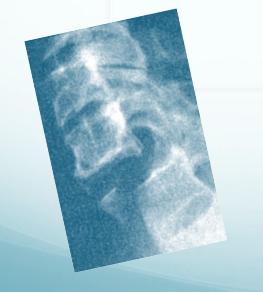 Common Adult Fractures - Spine