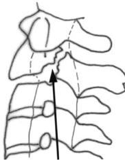 Hangman's fracture detail
