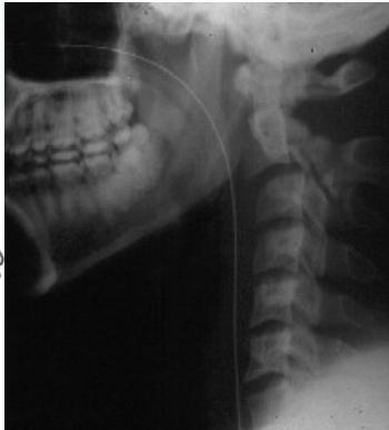 Hangman's fracture additional