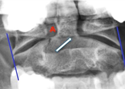 Odontoid fracture