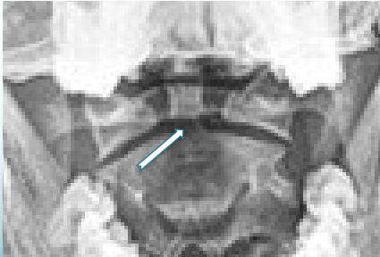 Odontoid fracture details