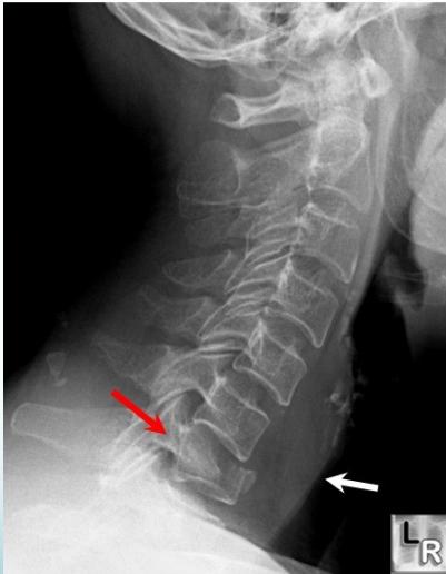 Burst fracture details