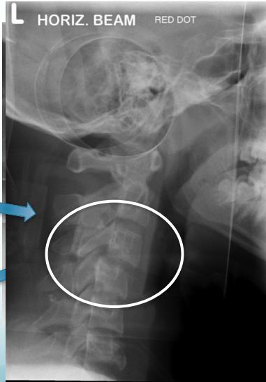 Fracture-dislocation