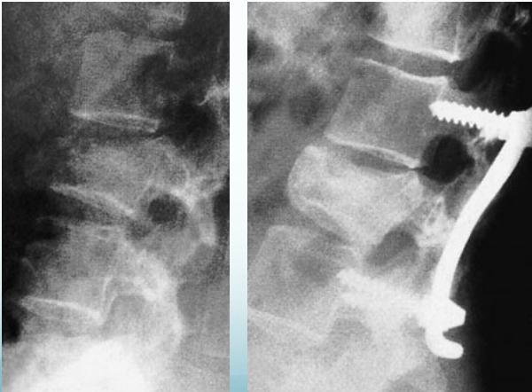 Unstable compression