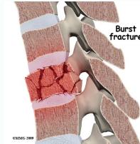 Burst injury