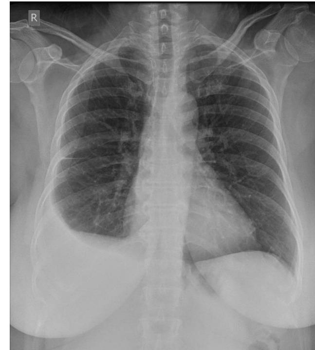 Pleural effusion