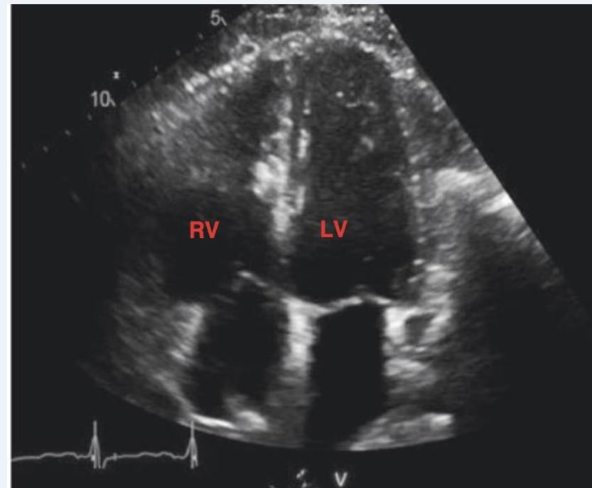 Apical four-chamber RV enlargement — image 1