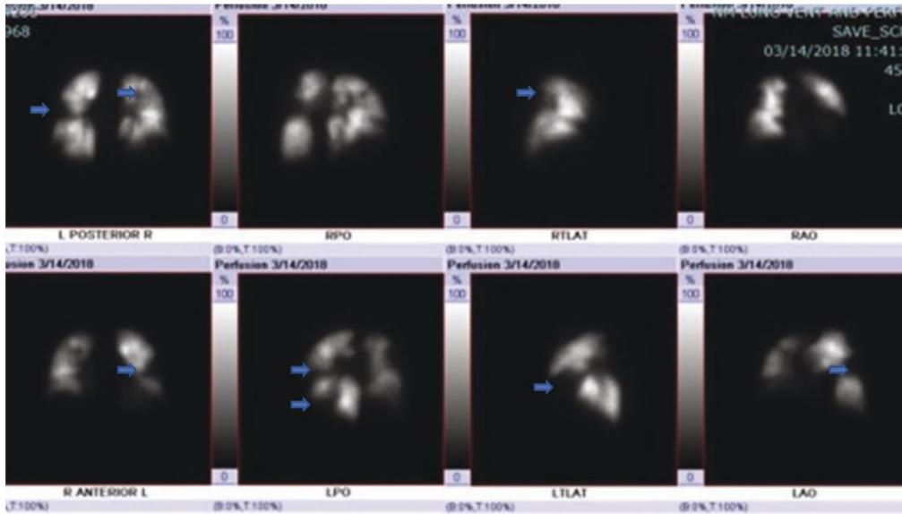 V/Q SPECT bilateral segmental perfusion defects