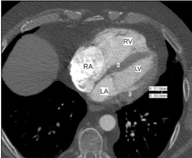 CT RV:LV internal-diameter ratio