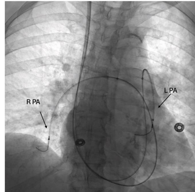 Catheter-directed thrombolysis catheters