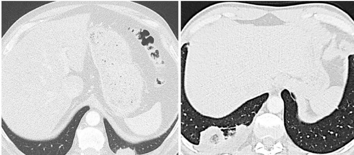 Pulmonary infarction and reversed-halo sign
