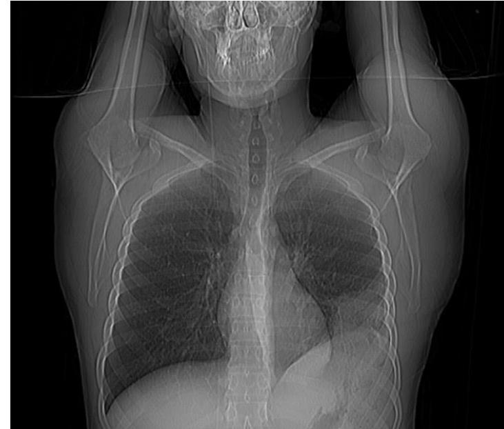 Hampton hump β pleural wedge-shaped infarct