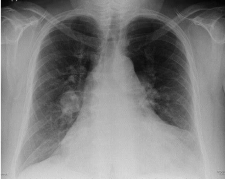 Fleischner sign — enlarged central pulmonary artery