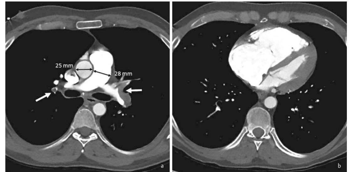 Pulmonary artery/aorta ratio and RV strain