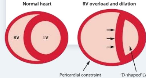 Right ventricular failure cascade