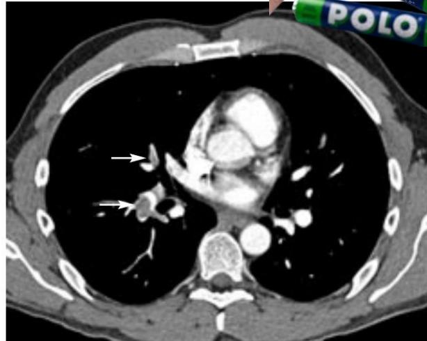 CTPA central filling defect — image 2