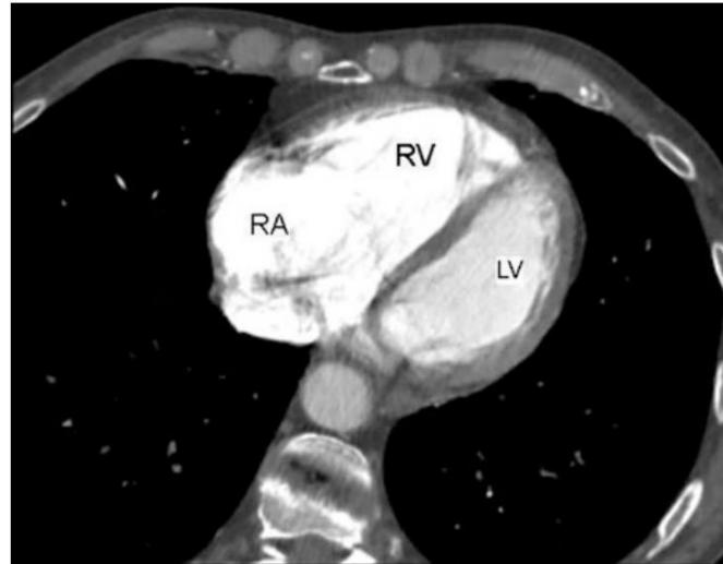 Interventricular septal bowing