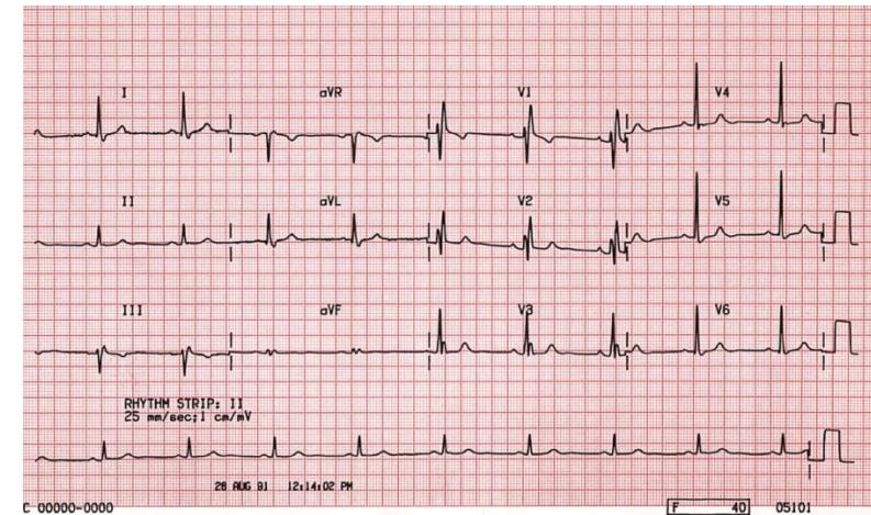 Right bundle branch block — example 1