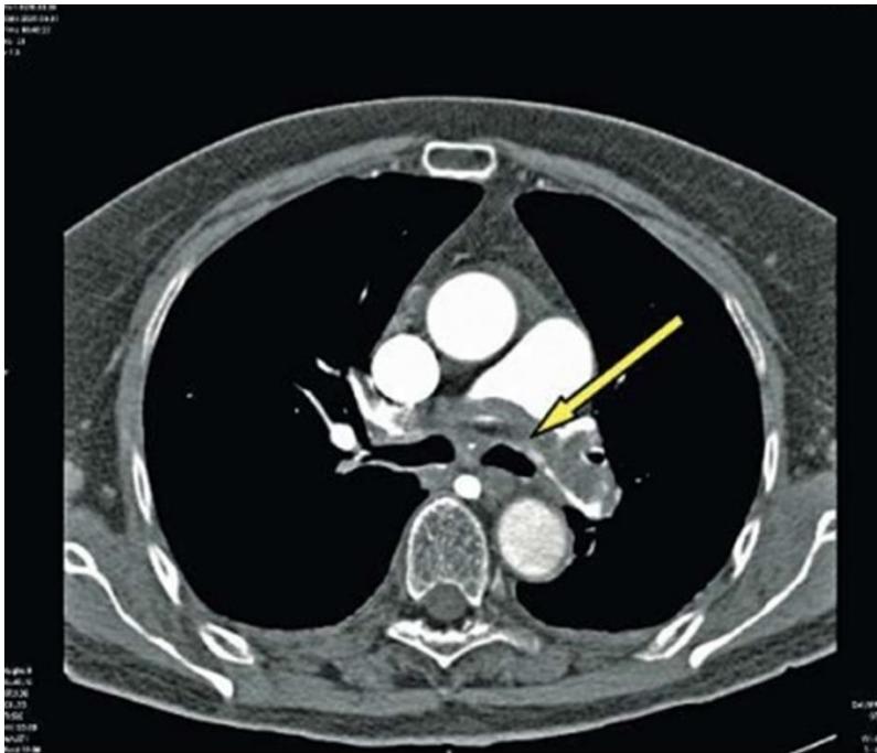 Saddle pulmonary embolus