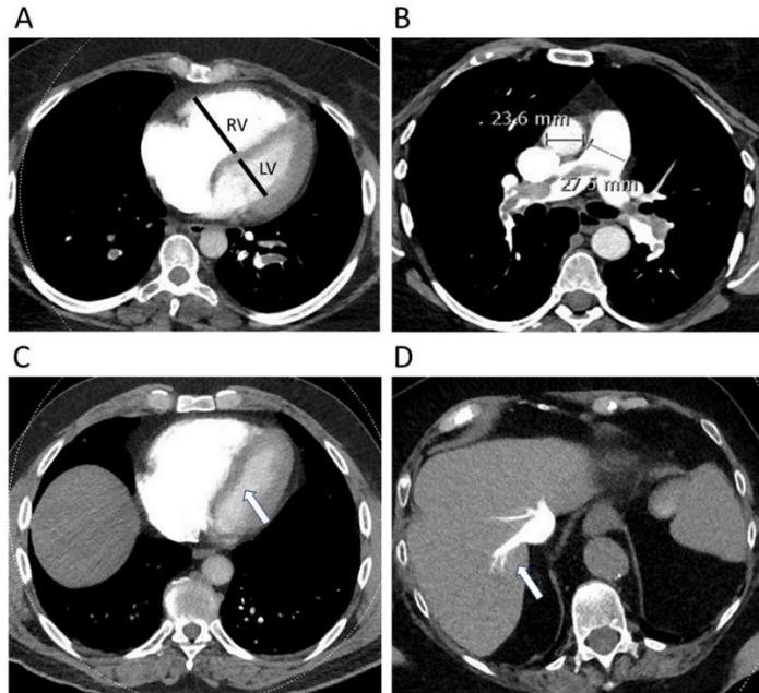 Four CT signs of RV strain