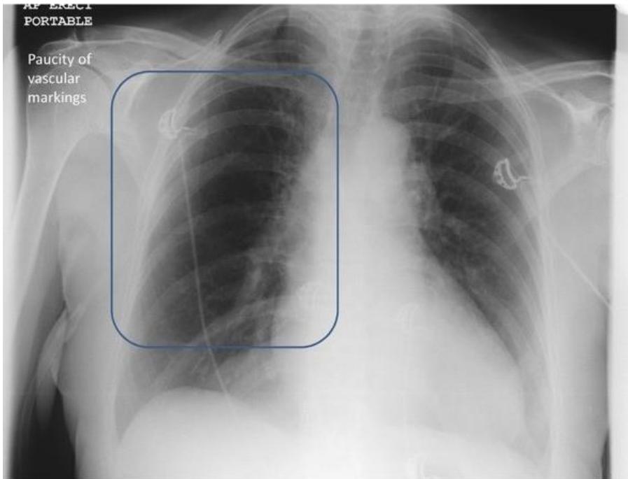 Westermark sign — regional oligemia