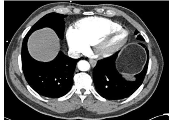 Right ventricular dilatation