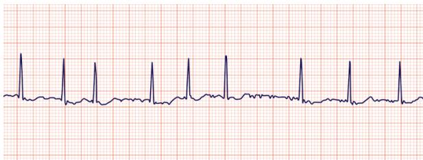 Right bundle branch block β example 2