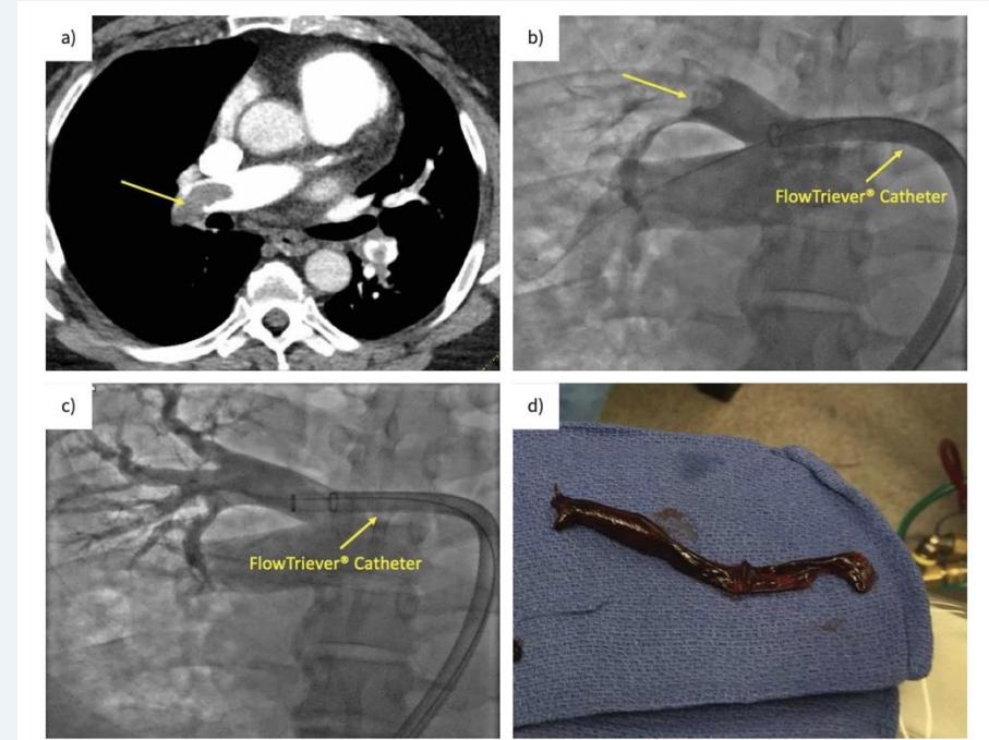 Mechanical aspiration thrombectomy and extracted clot