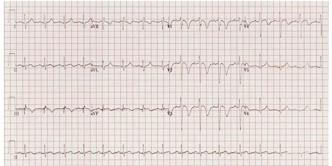 Right ventricular strain T-wave inversion