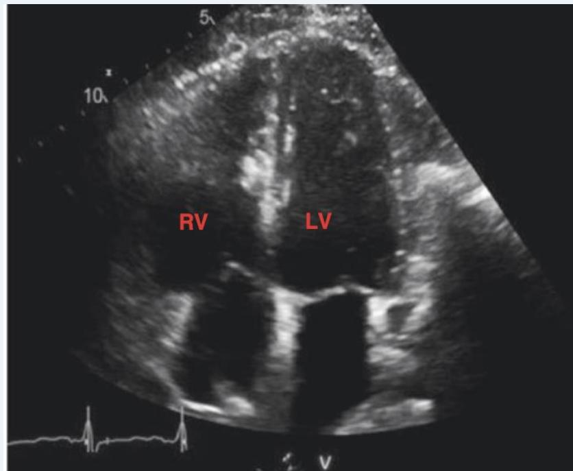 Apical four-chamber RV enlargement β image 2