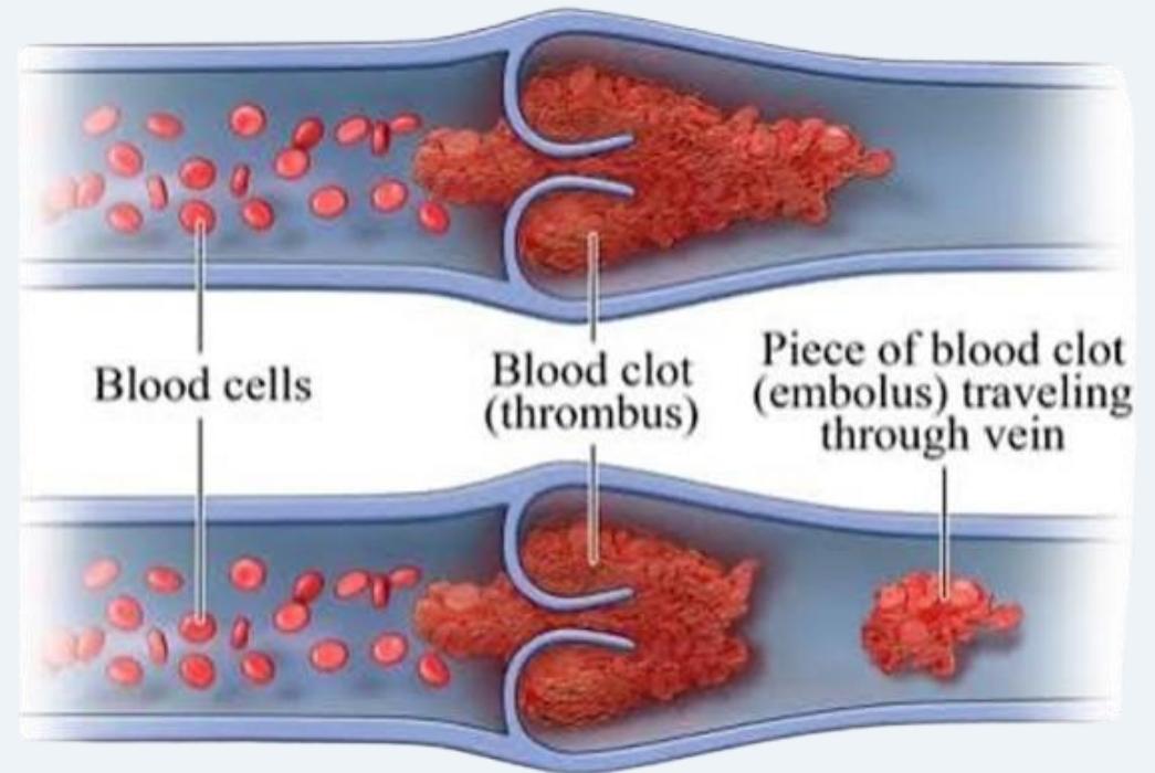 Thrombus versus embolus