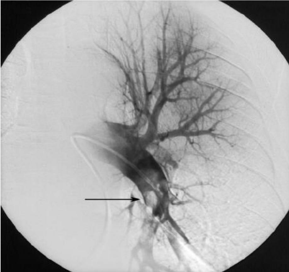 Invasive pulmonary angiography
