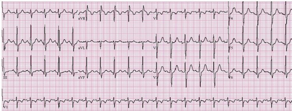 Sinus tachycardia