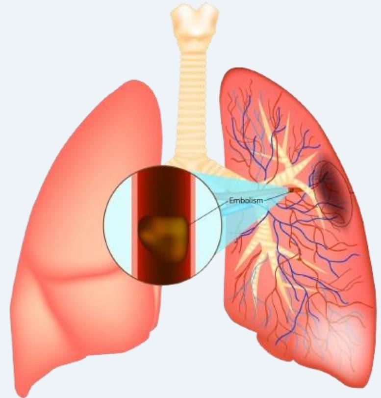 Definition and pulmonary vascular obstruction