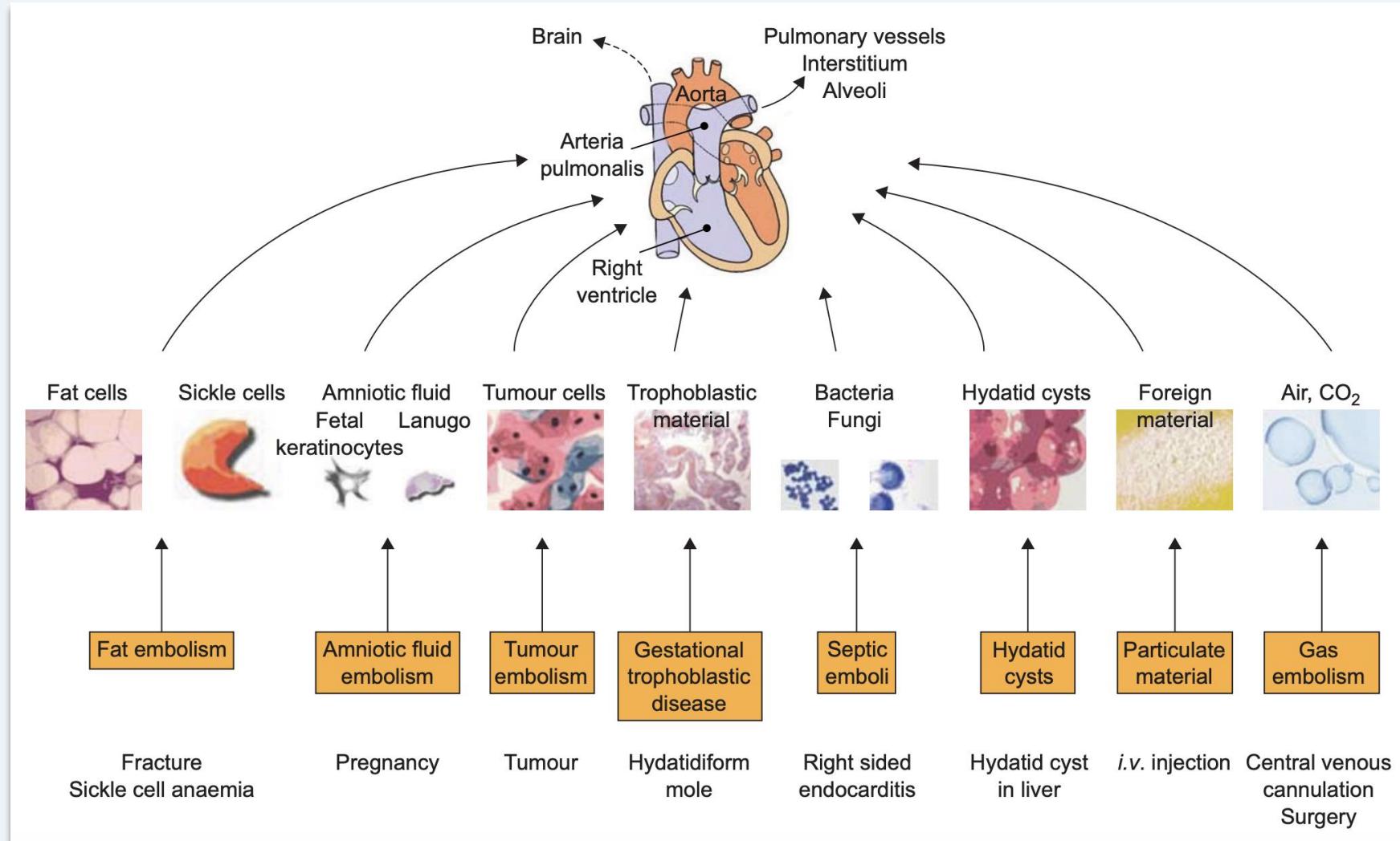 Non-thrombotic emboli overview