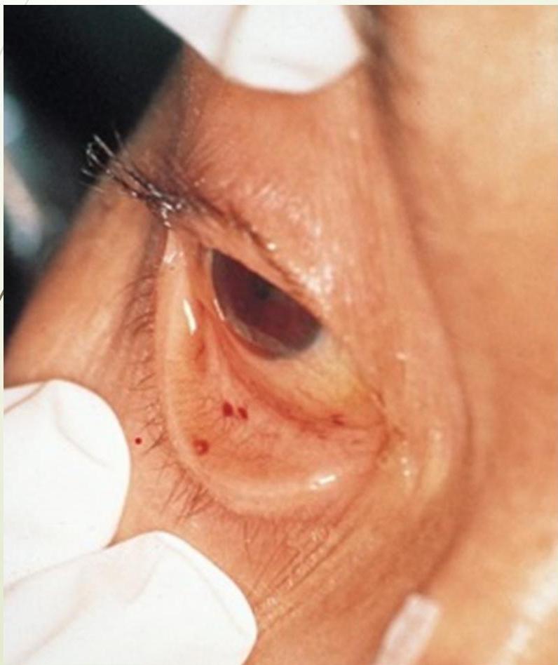 Conjunctival Petechiae 1|214x255