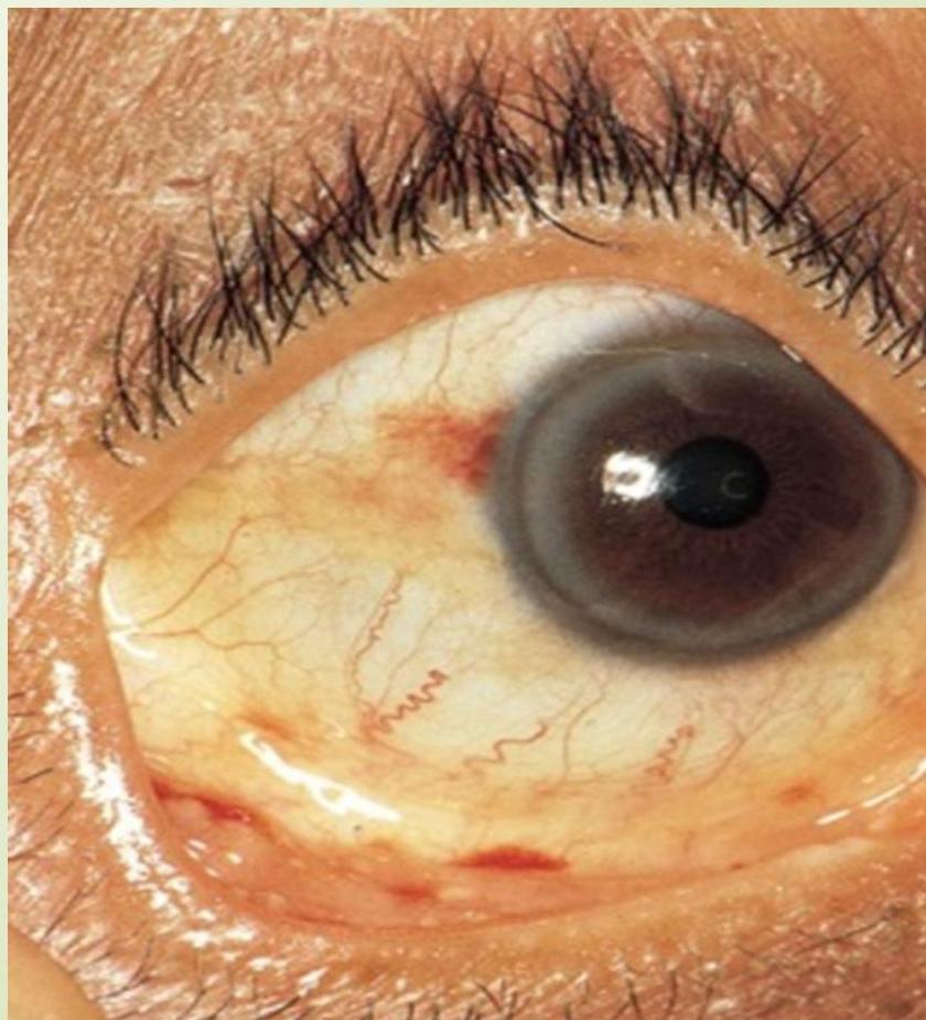 Conjunctival Petechiae 2|201x221