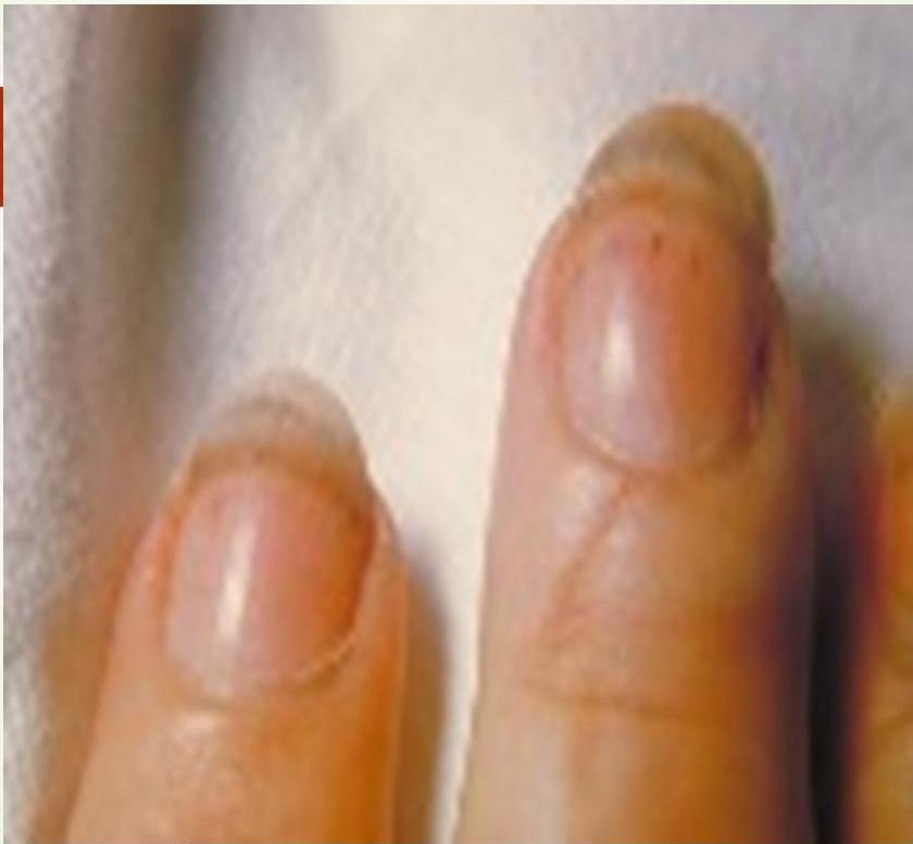 Splinter Hemorrhages 1|242x224