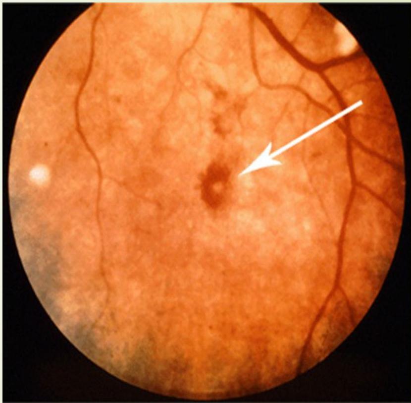Splinter Hemorrhages 2