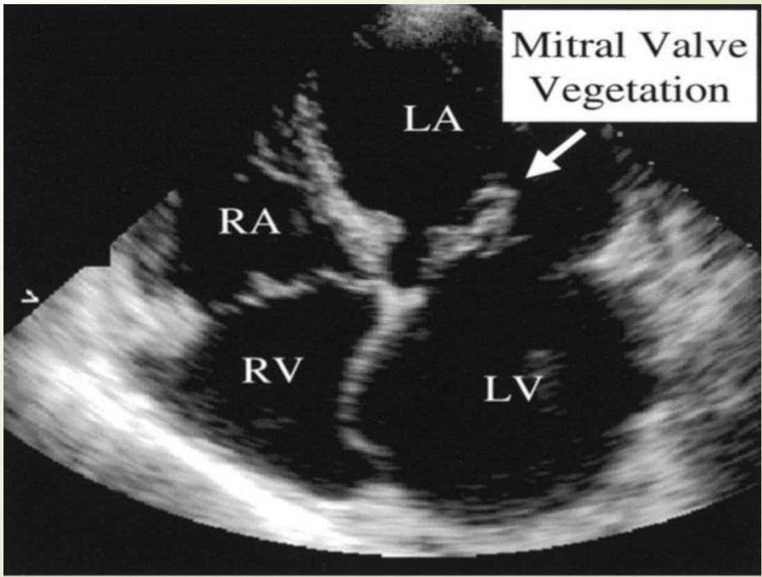 Mitral Valve Vegetation