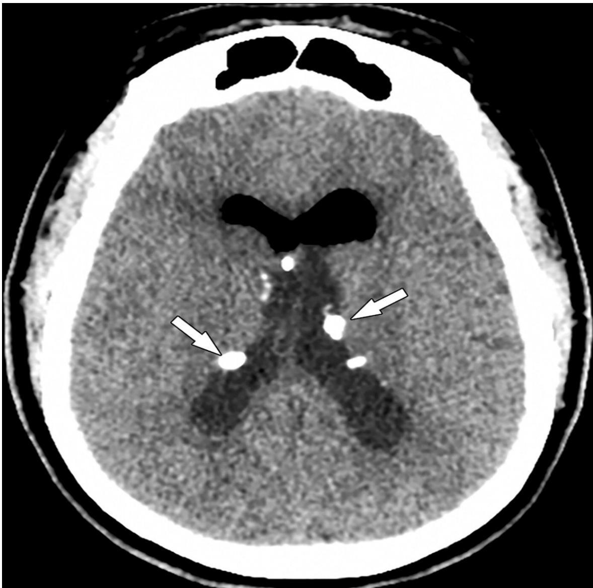 Subependymal calcification