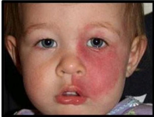 Tram track calcification