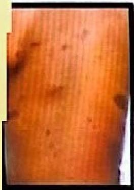 Café-au-lait macules